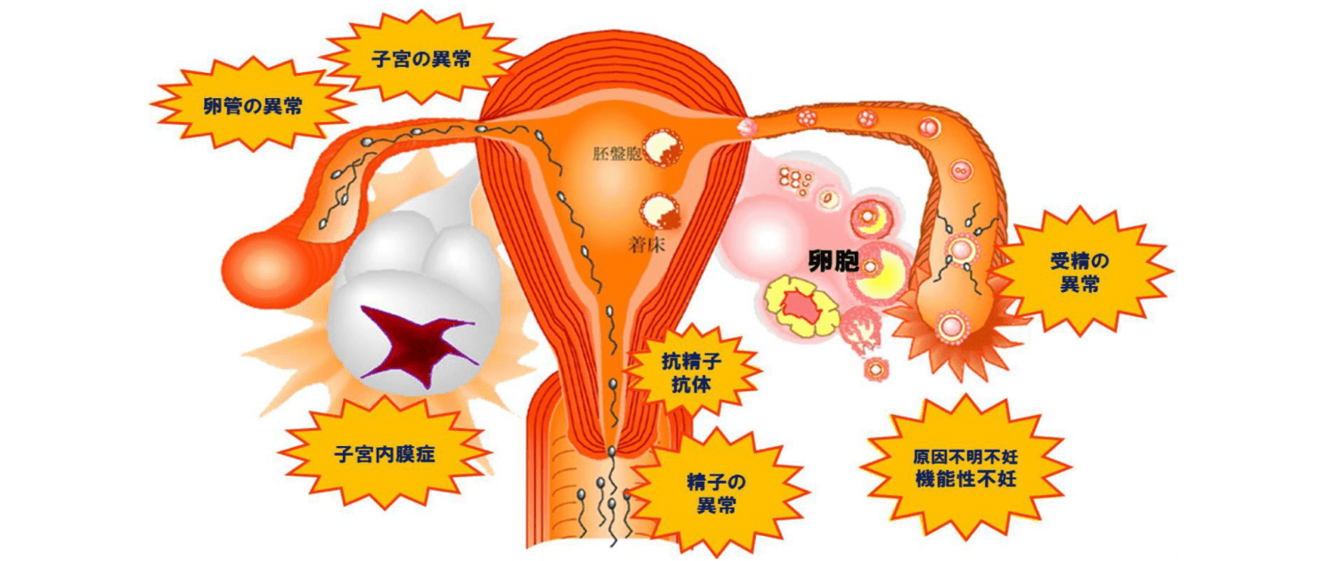 子宮の異常卵管の異常胚盤胞着床卵胞 6受精の抗精子抗体子宮内膜症精子の異常原因不明不妊機能性不好異常