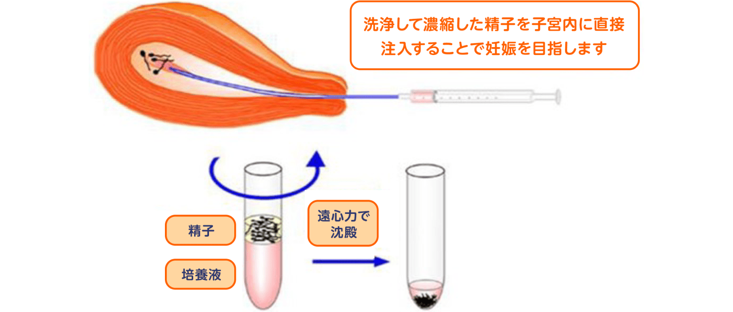 精子培養液洗浄して濃縮した精子を子宮内に直接注入することで妊娠を目指します遠心力で沈殿