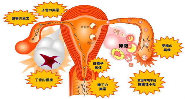 子宮の異常卵管の異常胚盤胞着床卵胞 6受精の抗精子抗体子宮内膜症精子の異常原因不明不妊機能性不好異常