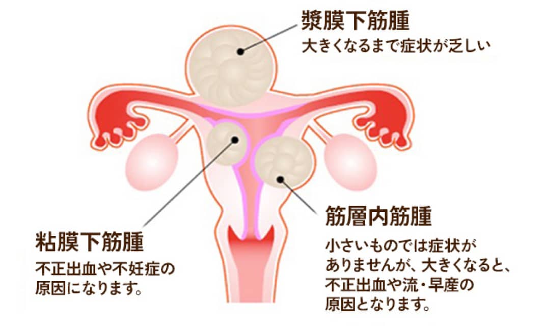 漿膜下筋腫：大きくなるまで症状が乏しい　粘膜下筋腫：不正出血や不妊症の原因になります。　筋層内筋腫：小さいものでは症状がありませんが、大きくなると、不正出血や流・早産の原因となります。