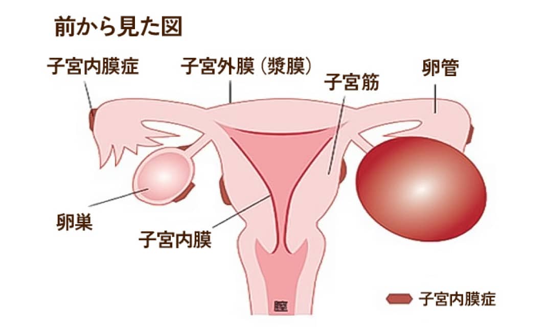 前から見た図　子宮内膜症 子宮外膜（漿膜） 子宮筋 卵管 卵巣 子宮内膜 子宮内膜症