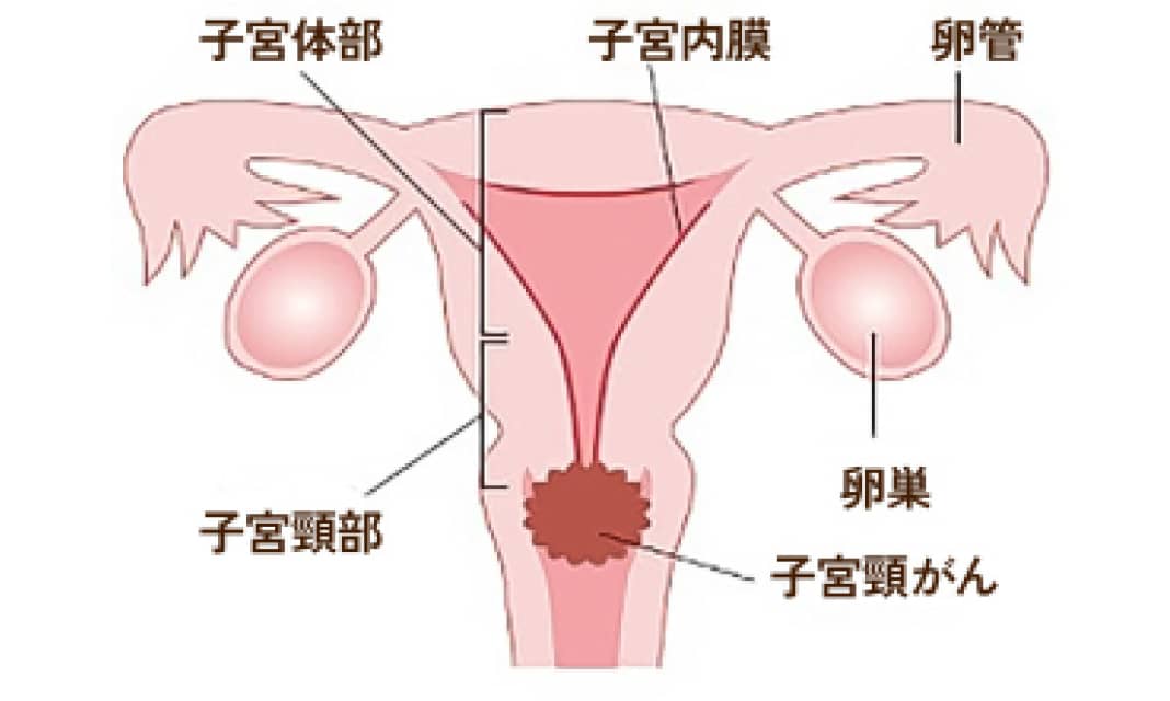 子宮体部 子宮内膜 卵管 子宮頸部 卵巣 子宮頸がん