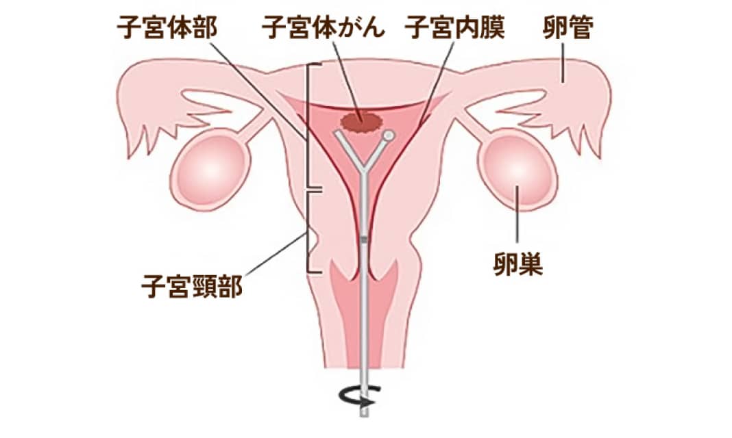 子宮体部 子宮体がん 子宮内膜 卵管 子宮頸部 卵巣